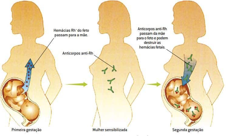 eritroblastose fetal