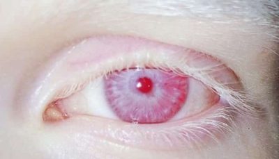 Cores dos olhos: quais são as mais comuns e as mais raras?